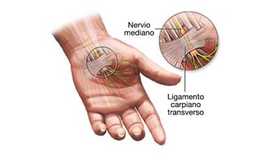 imagen ilustrativa tunel carpiano